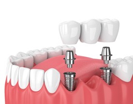 illustration implant dental bridge in Canton    