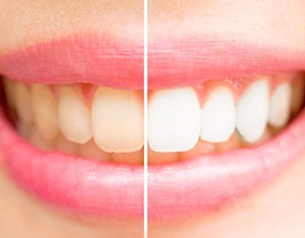 before and after picture of teeth whitening