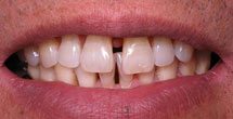 Patient with large gap between front teeth