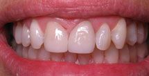 Bright white teeth