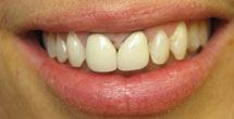Dark coloring around teeth at gums