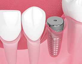 Digital illustration of dental implant