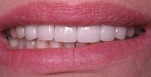 Brilliantly white smile after treatment