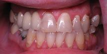 Discolored and decayed teeth