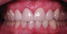 Front tooth repaired to natural healthy appearance