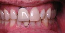Black coloring around front tooth