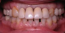 Decayed and discolored teeth