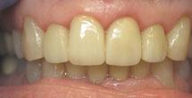 Healthy white teeth