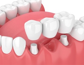 illustration traditional dental bridge in Canton  