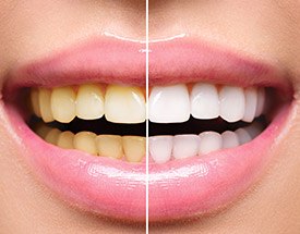 Closeup of smile before and after teeth whitening