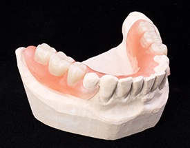 Model of smile with partial denture