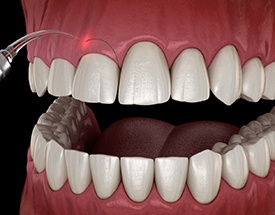 Digital image of gum recontouring