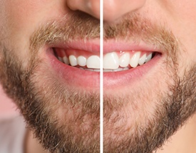 Before and after gum recontouring