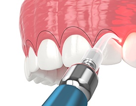 Digital image of a soft tissue laser performing gum recontouring