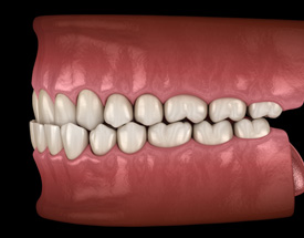 Illustration of an underbite