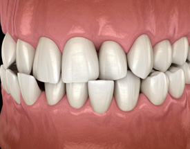 Illustration of a crossbite