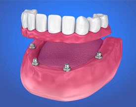 implant-retained denture