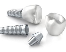 dental implants