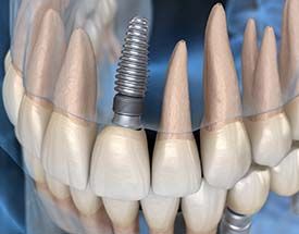 single dental implant in the upper arch 