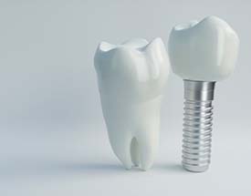 illustration of a dental implant and crown next to a natural tooth  yard 