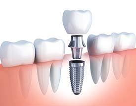 dental implant, abutment, and crown being placed in the jaw 