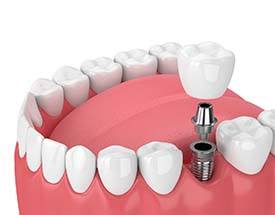 single dental implant holding a crown 