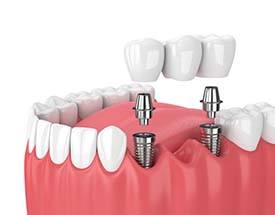 two dental implants holding a bridge 