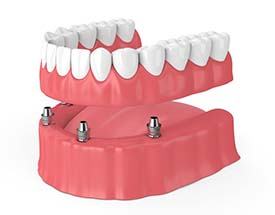 four dental implants holding a denture 