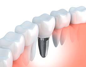 mini-dental implant replacing a single missing tooth 