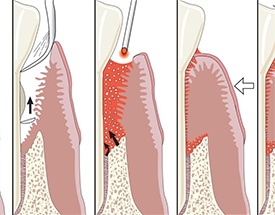 Animation of laser gum treatment