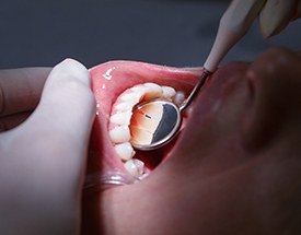 Closeup of smile during dental exam
