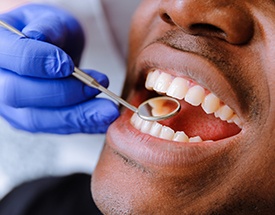 Closeup of smile during dental exam