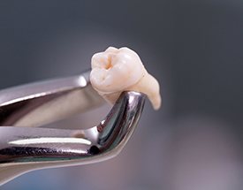 Metal forceps honding tooth
