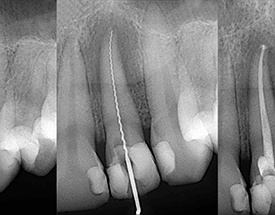 X-rays showing root canal treatment