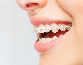 a close-up of a person with clear braces