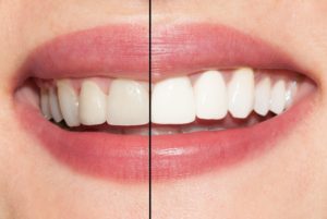 Before and after teeth whitening.