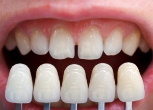 A row of veneers compared to natural teeth.