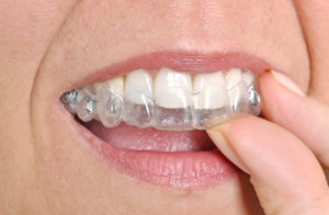 What Other Options Do I Have Besides Invisalign in Canton?