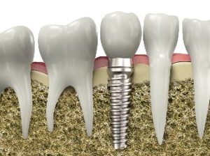 Model of an implant in a lower jaw