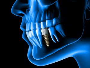 digital image of dental implant from dentist