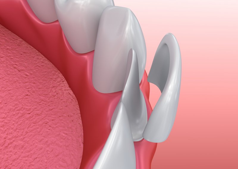 A 3D illustration of porcelain veneers