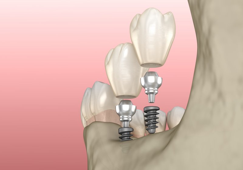 A 3D illustration of mini dental implants